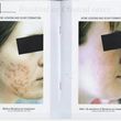 Photo #5: Bio-dermabrasion, Acne, Scars & Rejuvenation Facial