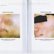 Photo #3: Bio-dermabrasion, Acne, Scars & Rejuvenation Facial