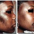 Photo #2: Bio-dermabrasion, Acne, Scars & Rejuvenation Facial