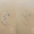 Photo #18: Renewal Laser Clinic - Best Tattoo Removal in Minnesota