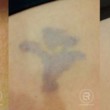 Photo #14: Renewal Laser Clinic - Best Tattoo Removal in Minnesota