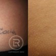 Photo #13: Renewal Laser Clinic - Best Tattoo Removal in Minnesota