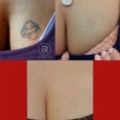 Photo #7: Renewal Laser Clinic - Best Tattoo Removal in Minnesota