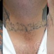 Photo #6: Renewal Laser Clinic - Best Tattoo Removal in Minnesota