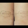 Photo #5: Renewal Laser Clinic - Best Tattoo Removal in Minnesota