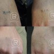 Photo #3: Renewal Laser Clinic - Best Tattoo Removal in Minnesota