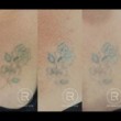 Photo #2: Renewal Laser Clinic - Best Tattoo Removal in Minnesota
