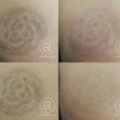 Photo #1: Renewal Laser Clinic - Best Tattoo Removal in Minnesota